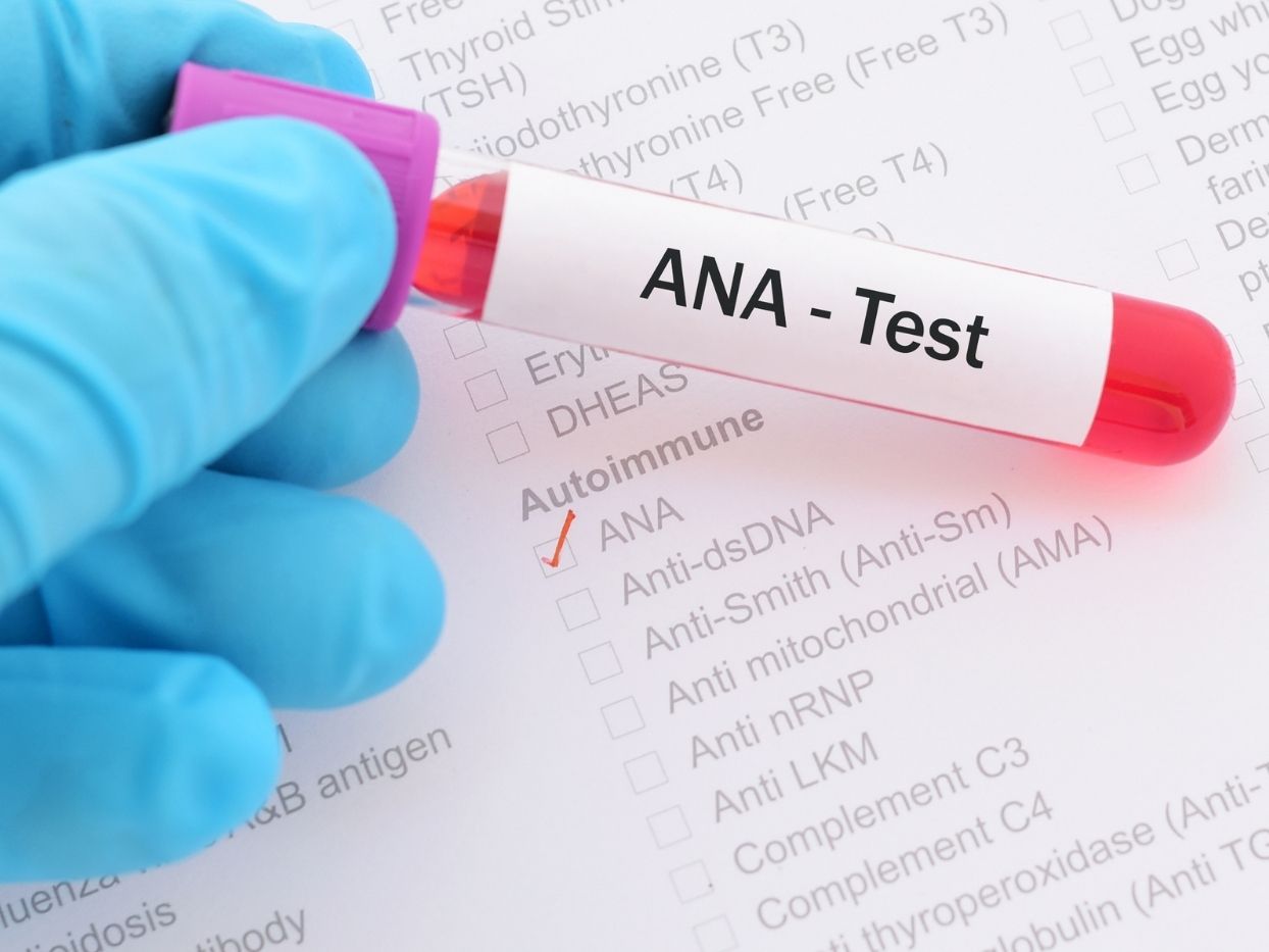 Antinuclear-Antibody-Test