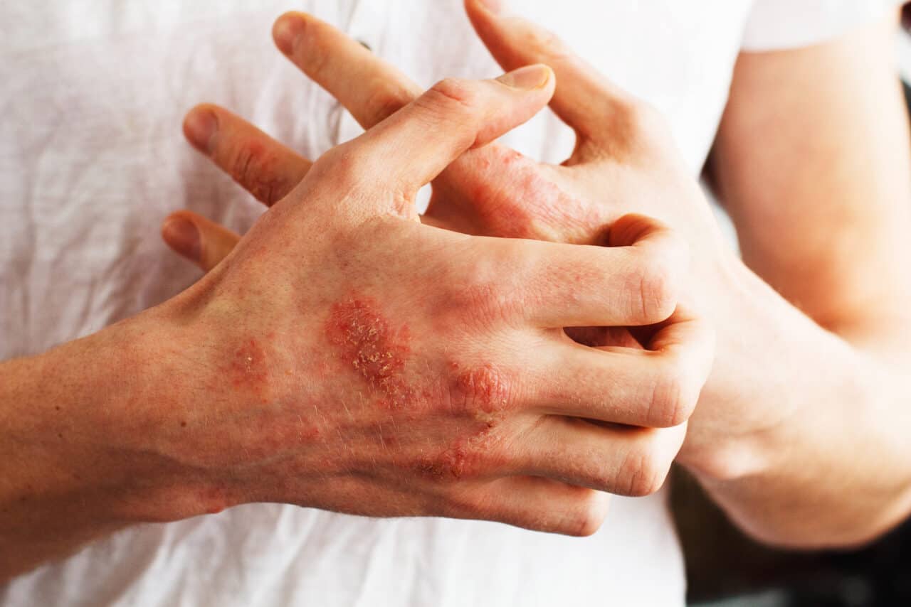 autoimmune disease